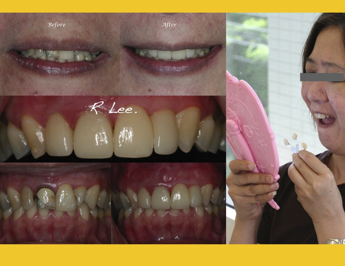 Porcelain crowns and veneers